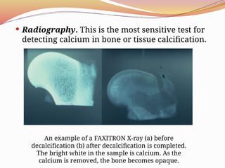 Comprehensive Overview of Bone Tumors: Classification, Grading, and ...