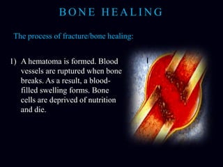 Bonefracture 091120114305-phpapp02 | PPTX