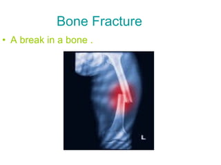Bone Fracture 
• A break in a bone . 
 