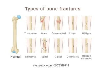 Bone – fracture and its repair for bsc 2nd year .pptx
