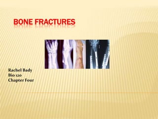 Bone Fractures Rachel Bady  Bio 120 Chapter Four 