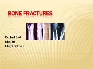 Bone Fractures Rachel Bady  Bio 120 Chapter Four 