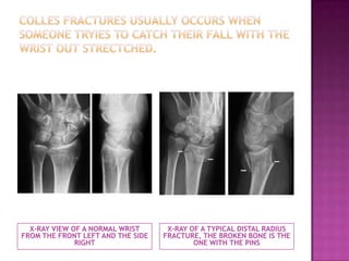 Left Colles Bone Fractures | PPTX