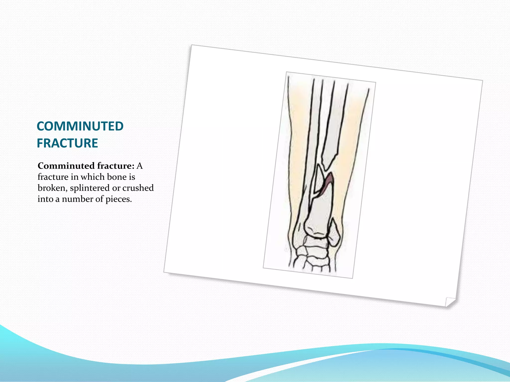 Bone Fractures Ppt Bone Fractures Ppt