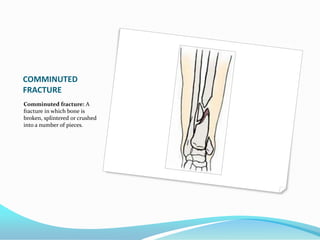 COMMINUTED FRACTUREComminuted fracture: A fracture in which bone is broken, splintered or crushed into a number of pieces. 
