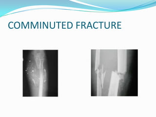 COMMINUTED FRACTURE