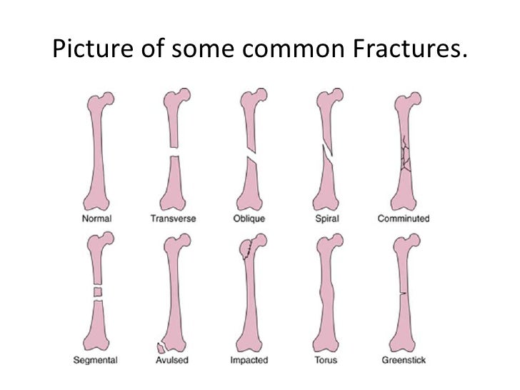 Bone fractures