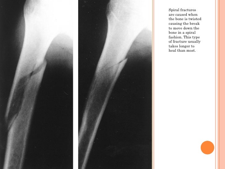 Bone fractures