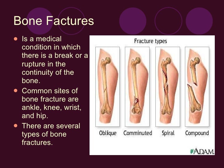 Bone fractures#4presentation