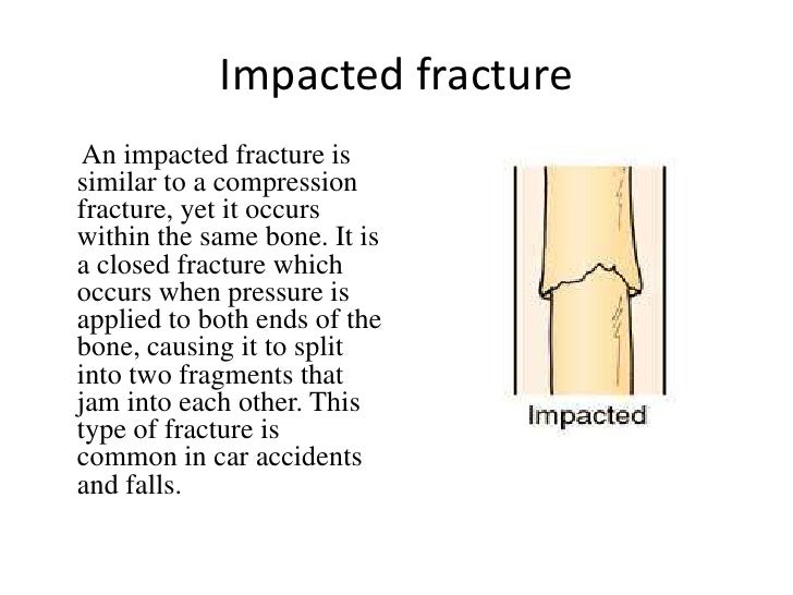 Bone Fractures Power Point Bone Fractures Power Point