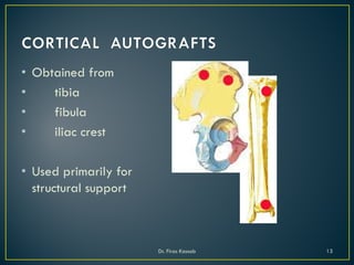 • Obtained from
• tibia
• fibula
• iliac crest
• Used primarily for
structural support
Dr. Firas Kassab 13
 