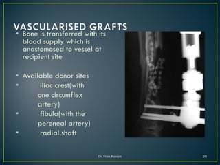 • Bone is transferred with its
blood supply which is
anastomosed to vessel at
recipient site
• Available donor sites
• iliac crest(with
one circumflex
artery)
• fibula(with the
peroneal artery)
• radial shaft
Dr. Firas Kassab 20
 