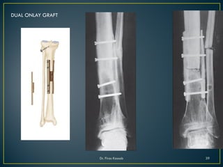 DUAL ONLAY GRAFT
Dr. Firas Kassab 39
 