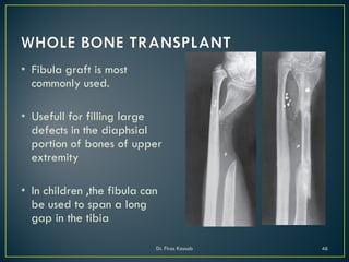 • Fibula graft is most
commonly used.
• Usefull for filling large
defects in the diaphsial
portion of bones of upper
extremity
• In children ,the fibula can
be used to span a long
gap in the tibia
Dr. Firas Kassab 46
 