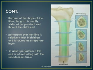 • Because of the shape of the
tibia, the graft is usually
wider at the proximal end
than at the distal end.
• periosteum over the tibia is
relatively thick in children
and is sutured as a separate
layer
• in adults periosteum is thin
and is sutured along with the
subcutaneous tissue
Dr. Firas Kassab 49
 