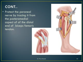 • Protect the peroneal
nerve by tracing it from
the posteromedial
aspect of of the distal
end of biceps femoris
tendon.
Dr. Firas Kassab 52
 
