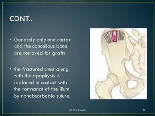 • Generaly only one cortex
and the cancellous bone
are removed for grafts
• the fractured crest along
with the apophysis is
replaced in contact with
the remnanat of the ilium
by nonabsorbable suture.
Dr. Firas Kassab 56
 