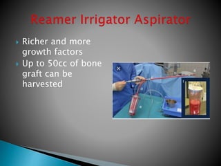  Richer and more
growth factors
 Up to 50cc of bone
graft can be
harvested
 