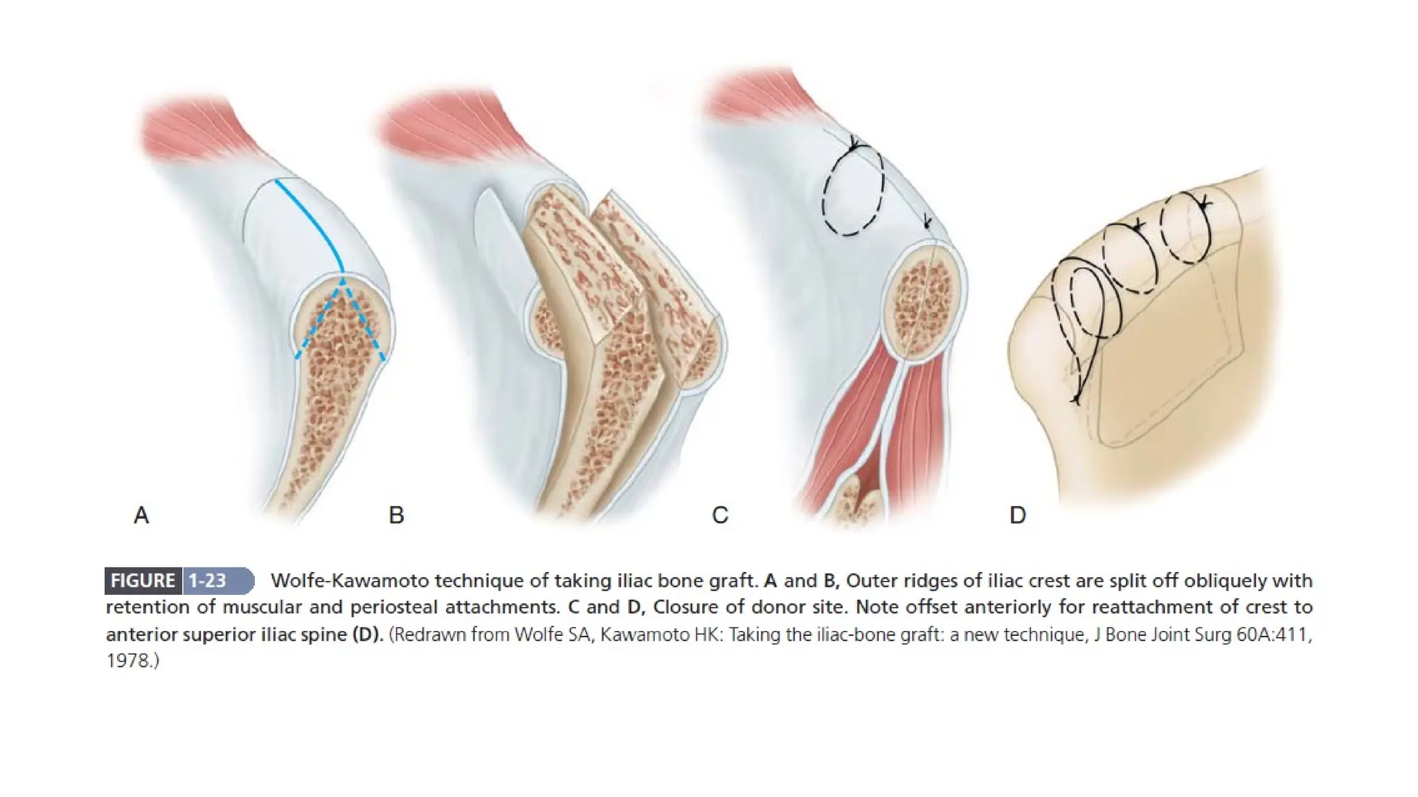 Bone graft Dr bikrant.pptx bone graft substitute | PPTX