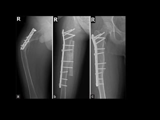Uses
• Malunited, nonunited fractures of shaft of
long bone
• Bridging joints to produce arthrodesis
• Fixation is achieve...