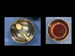 Bone grafting Options and Substitutes | PPTX