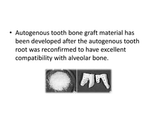 • Autogenous tooth bone graft material has
been developed after the autogenous tooth
root was reconfirmed to have excellent
compatibility with alveolar bone.
 