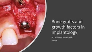 Bone grafts and
growth factors in
Implantology
Dr Lakkireddy Vasavi reddy
II MDS
 