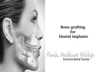Bone grafting 
for 
Dental implants

 