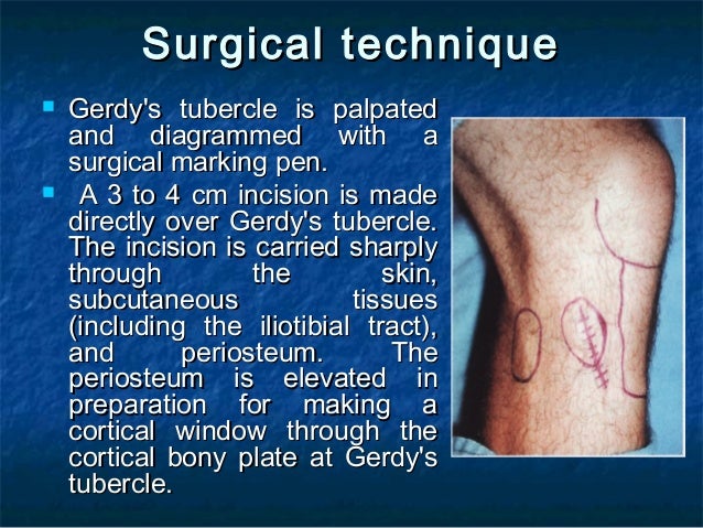 bone-grafts-in-oral-surgery-58-638.jpg?cb=1431538280