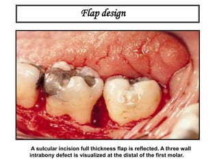 A sulcular incision full thickness flap is reflected. A three wall
intrabony defect is visualized at the distal of the first molar.
Flap design
 