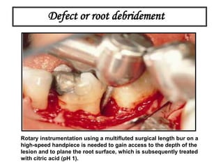 Defect or root debridement
Rotary instrumentation using a multifluted surgical length bur on a
high-speed handpiece is needed to gain access to the depth of the
lesion and to plane the root surface, which is subsequently treated
with citric acid (pH 1).
 