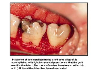 Placement of demineralized freeze-dried bone allograft is
accomplished with light incremental pressure so that the graft
overfills the defect. The root surface has been treated with citric
acid (pH 1) and the defect has been decorticated.
 