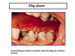 Flap closure
A monofilament suture is used to close the flaps by primary
closure.
 