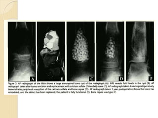 bone graft, substitute, BMP.ppt