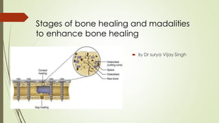 Stages of bone healing and madalities
to enhance bone healing
 By Dr surya Vijay Singh
 