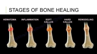 bone healing.pptx