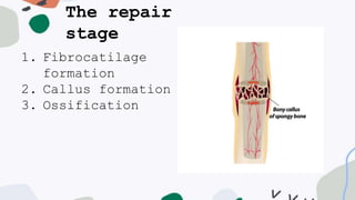 The repair
stage
1. Fibrocatilage
formation
2. Callus formation
3. Ossification
 