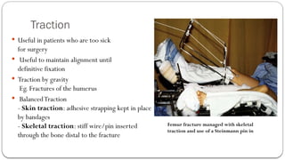 Traction Use BONE HEALING General Medicine, surgery mosyt | PPTX