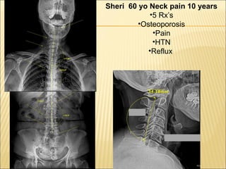 Sheri 60 yo Neck pain 10 years
•5 Rx’s
•Osteoporosis
•Pain
•HTN
•Reflux
 