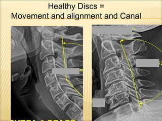 Healthy Discs =
Movement and alignment and Canal
 