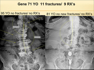 Gene 71 YO 11 fractures/ 9 RX’s
95 YO no fractures/ no RX’s 81 YO no new fractures/ no RX’s
 