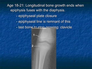 Age 18-21: Longitudinal bone growth ends whenAge 18-21: Longitudinal bone growth ends when
epiphysis fuses with the diaphysis.epiphysis fuses with the diaphysis.
- epiphyseal plate closure- epiphyseal plate closure
- epiphyseal line is remnant of this- epiphyseal line is remnant of this
- last bone to stop growing: clavicle- last bone to stop growing: clavicle
 