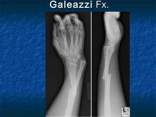 GaleazziGaleazzi Fx.Fx.
 