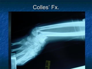 Colles’ Fx.Colles’ Fx.
 