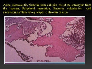 Acute steomyelitis. Nonvital bone exhibits loss of the osteocytes from
the lacunae. Peripheral resorption. Bacterial colonization. And
surrounding inflammatory response also can be seen .
 