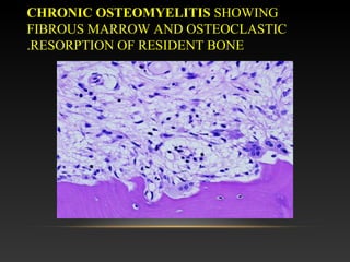 CHRONIC OSTEOMYELITIS SHOWING
FIBROUS MARROW AND OSTEOCLASTIC
RESORPTION OF RESIDENT BONE.
 