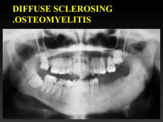 DIFFUSE SCLEROSING
OSTEOMYELITIS.
 