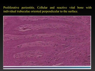 Proliferative periostitis. Cellular and reactive vital bone with
individual trabeculae oriented perpendicular to the surface.
 