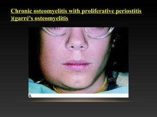 Chronic osteomyelitis with proliferative periostitis
(garré's osteomyelitis(
 