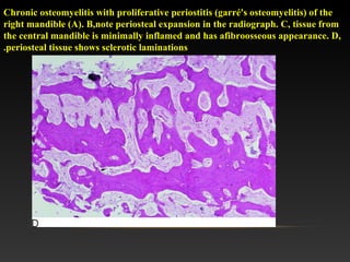 Chronic osteomyelitis with proliferative periostitis (garré's osteomyelitis( of the
right mandible (A(. B,note periosteal expansion in the radiograph. C, tissue from
the central mandible is minimally inflamed and has afibroosseous appearance. D,
periosteal tissue shows sclerotic laminations.
 